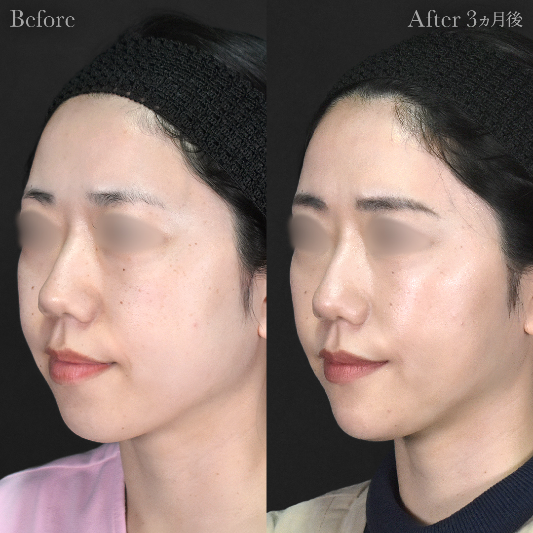 【30代女性】脂肪吸引（顔2部位）＋エラボトックス注射＋顎プロテーゼ挿入｜3ヵ月後