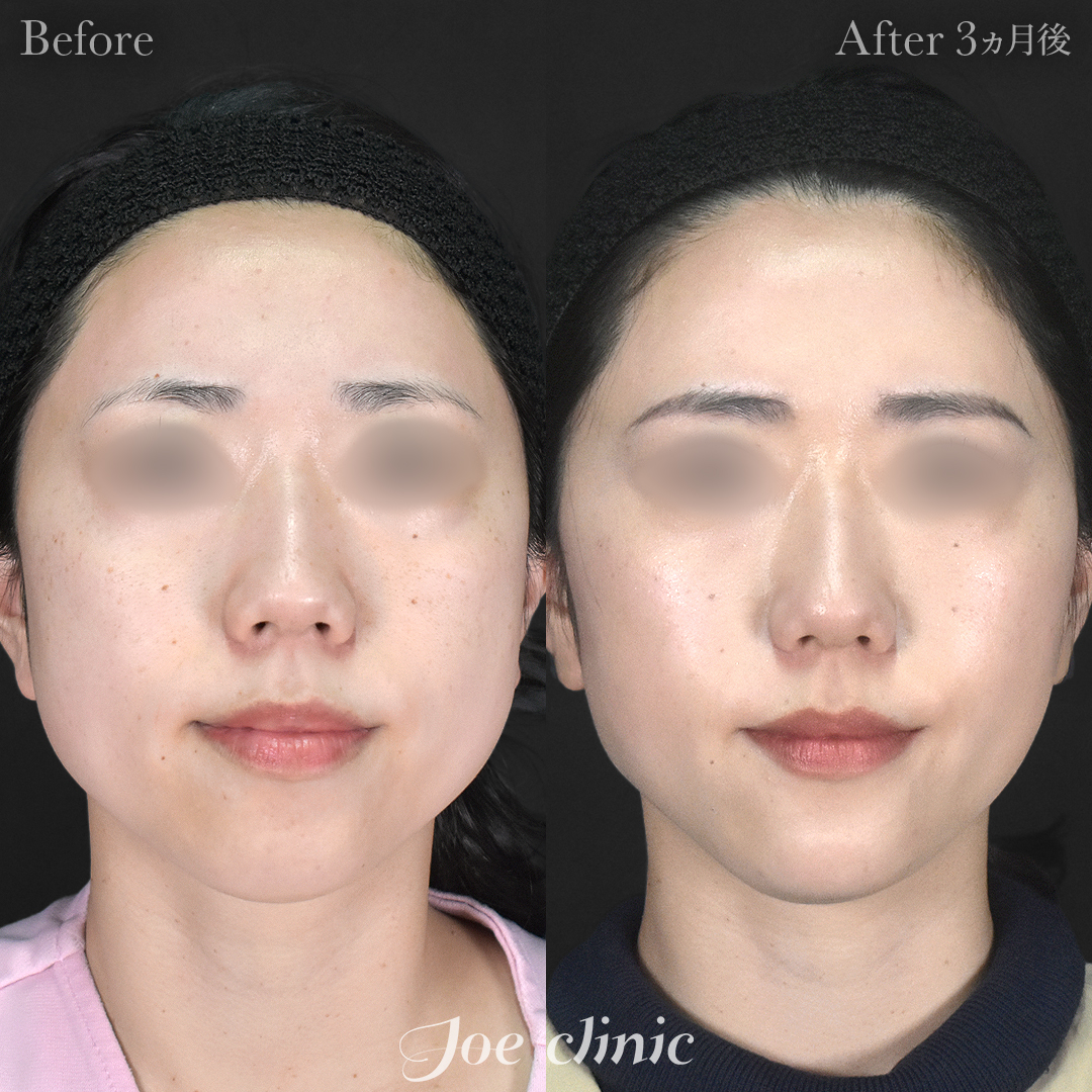 【30代女性】脂肪吸引（顔2部位）＋エラボトックス注射＋顎プロテーゼ挿入｜3ヵ月後