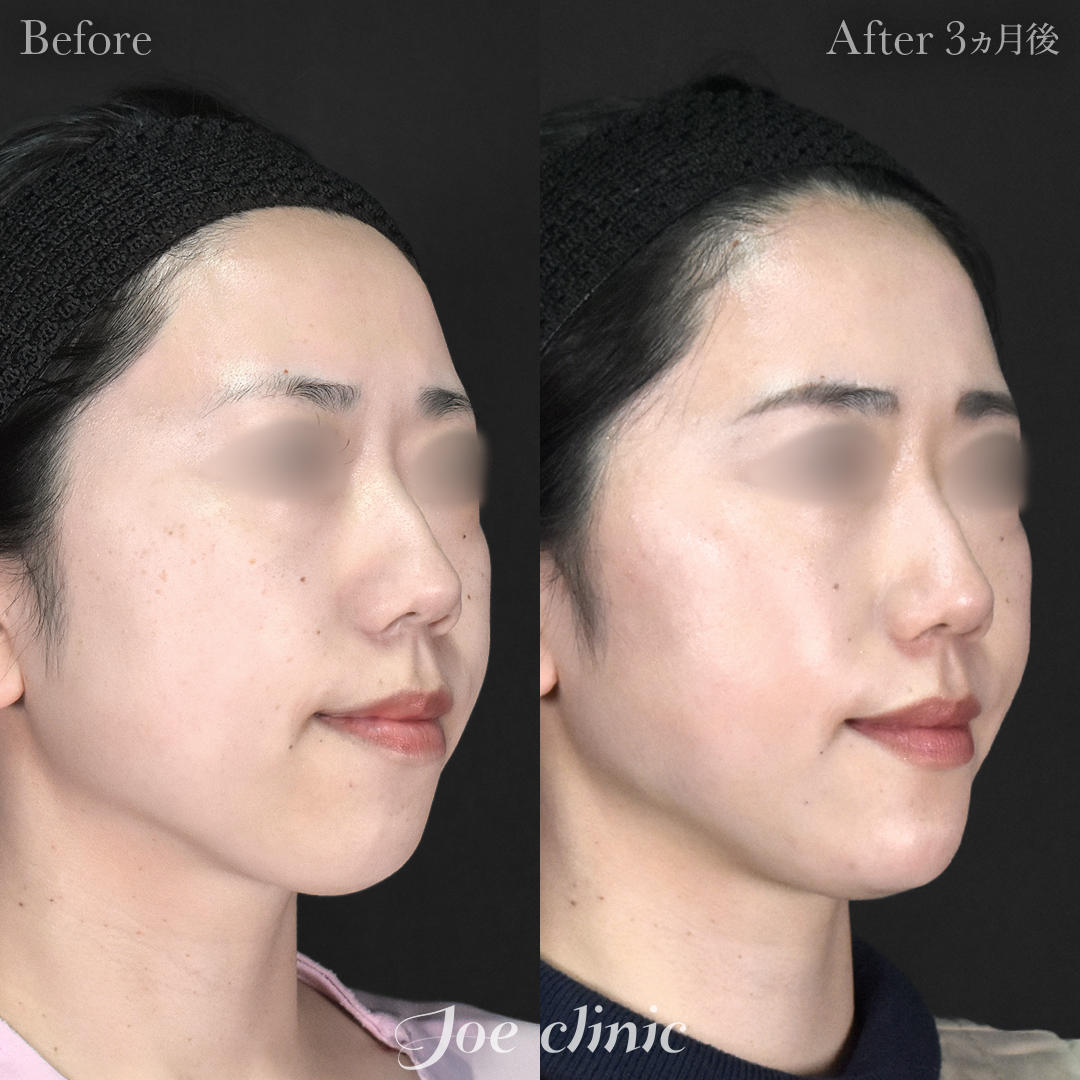 【30代女性】脂肪吸引（顔2部位）＋エラボトックス注射＋顎プロテーゼ挿入｜3ヵ月後