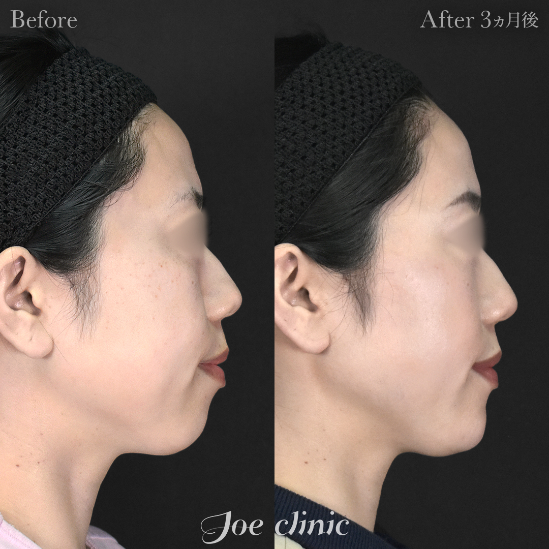 【30代女性】脂肪吸引（顔2部位）＋エラボトックス注射＋顎プロテーゼ挿入｜3ヵ月後