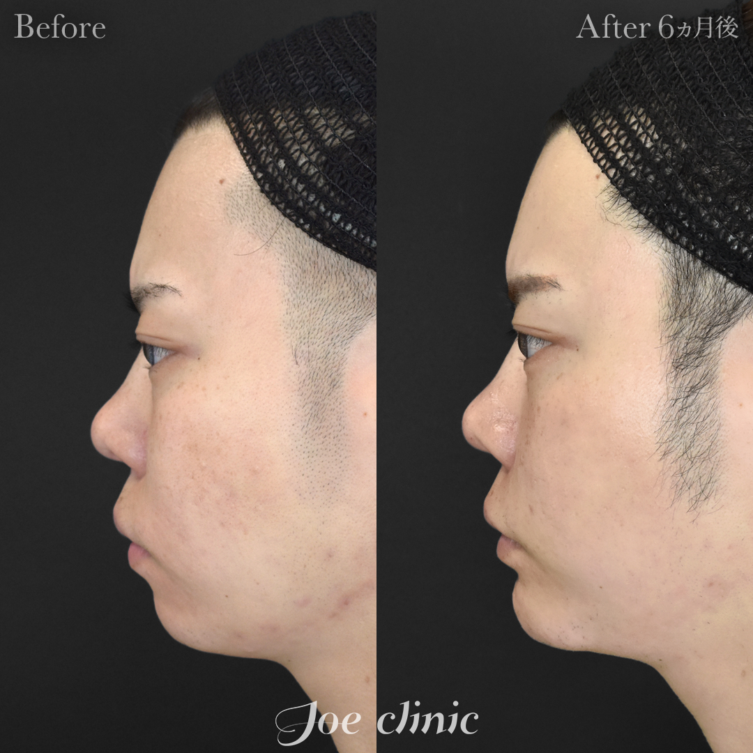 【20代男性】貴族手術（鼻翼基部プロテーゼ挿入術）＋顎プロテーゼ挿入｜6ヵ月後
