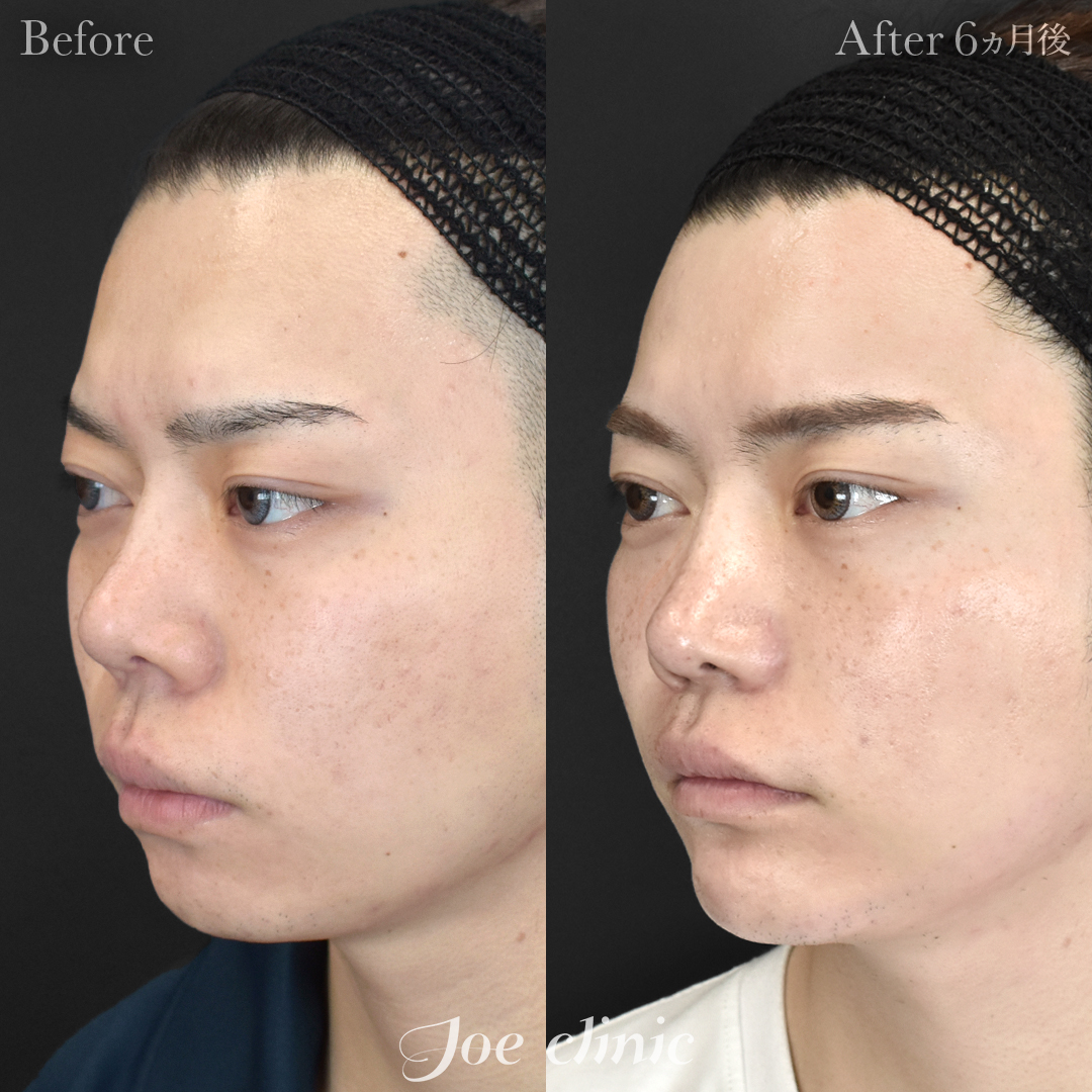 【20代男性】貴族手術（鼻翼基部プロテーゼ挿入術）＋顎プロテーゼ挿入｜6ヵ月後