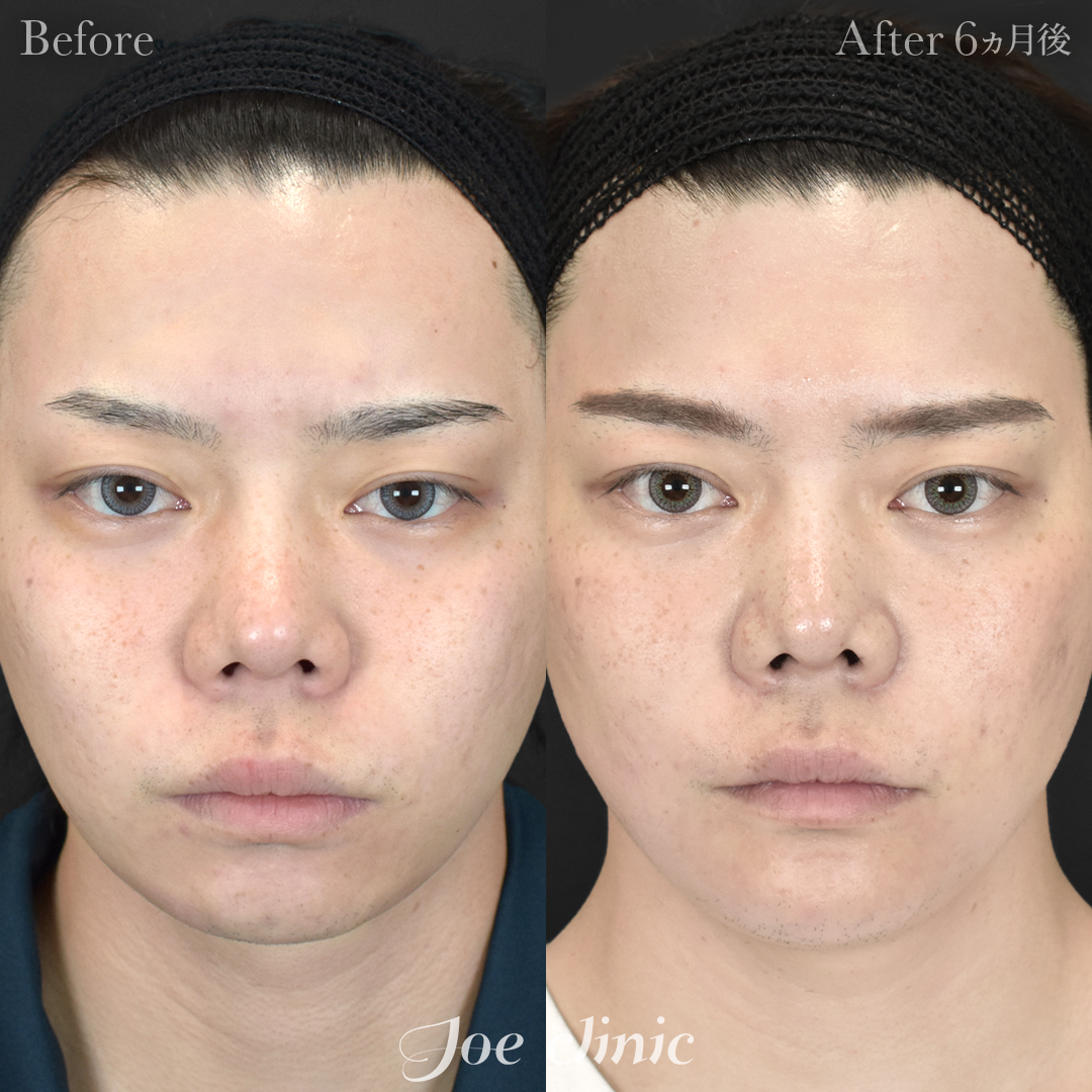 【20代男性】貴族手術（鼻翼基部プロテーゼ挿入術）＋顎プロテーゼ挿入｜6ヵ月後