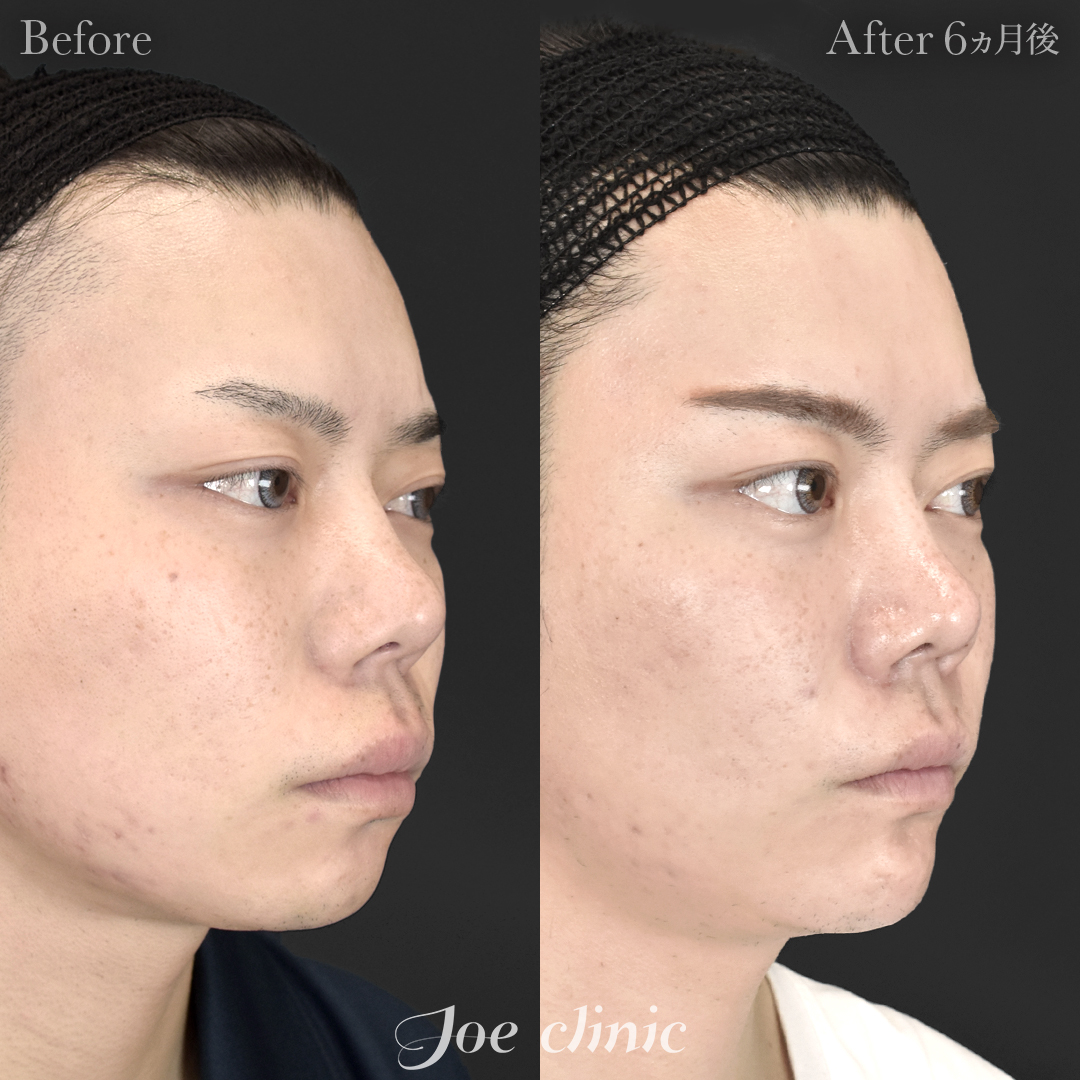 【20代男性】貴族手術（鼻翼基部プロテーゼ挿入術）＋顎プロテーゼ挿入｜6ヵ月後