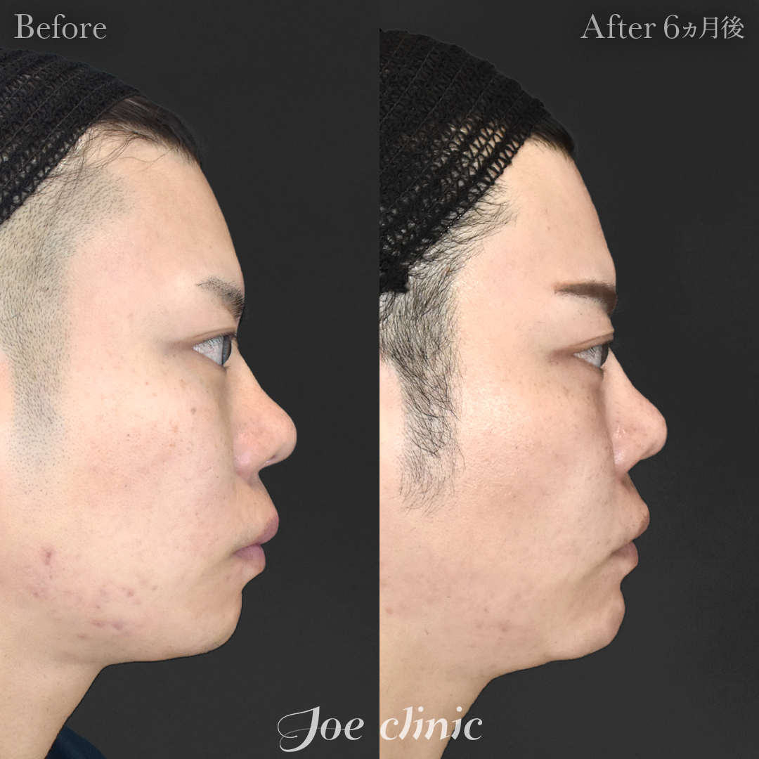 【20代男性】貴族手術（鼻翼基部プロテーゼ挿入術）＋顎プロテーゼ挿入｜6ヵ月後