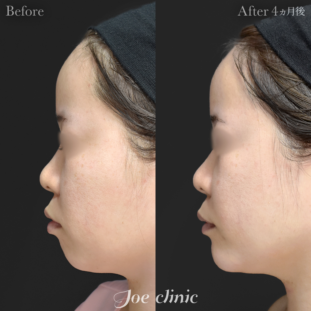 【20代女性】貴族手術（鼻翼基部プロテーゼ挿入術）＋顎プロテーゼ挿入｜4ヵ月後