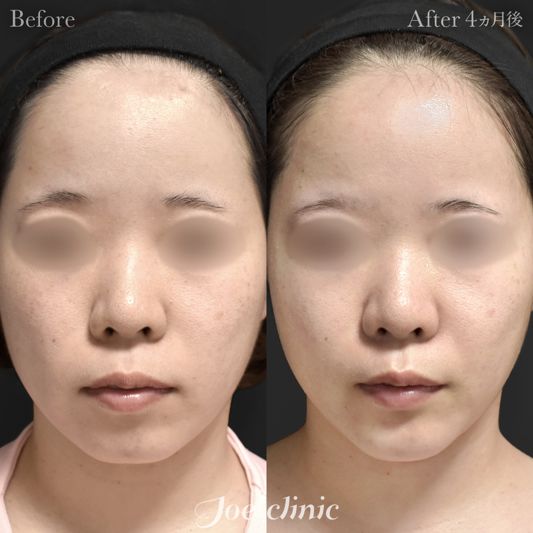 【20代女性】貴族手術(鼻翼基部プロテーゼ挿入術)+顎プロテーゼ挿入|4ヵ月後