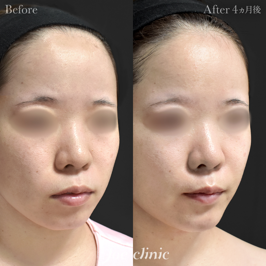 【20代女性】貴族手術(鼻翼基部プロテーゼ挿入術)+顎プロテーゼ挿入|4ヵ月後