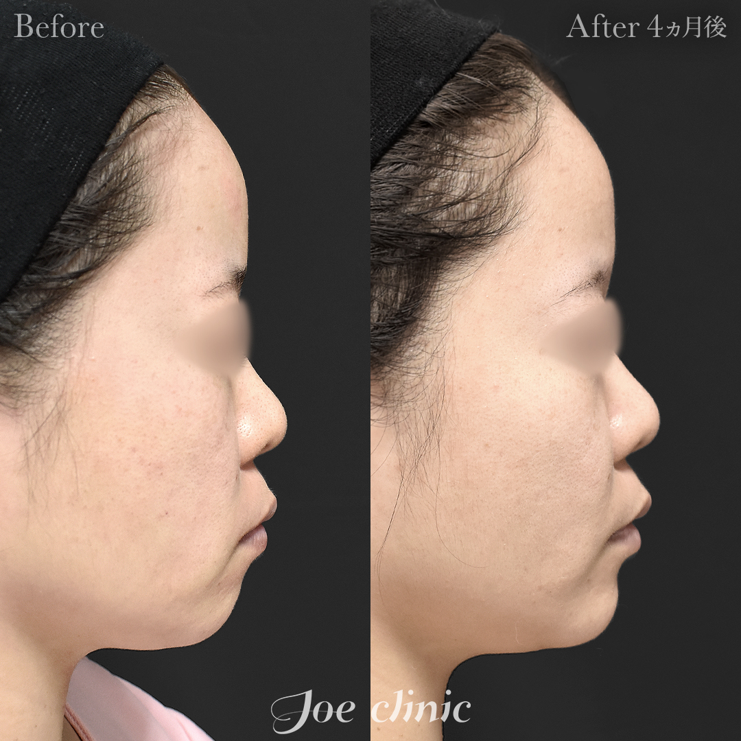 【20代女性】貴族手術(鼻翼基部プロテーゼ挿入術)+顎プロテーゼ挿入|4ヵ月後