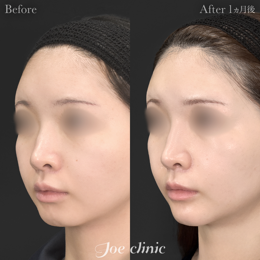 【20代女性】貴族手術（鼻翼基部プロテーゼ挿入術）＋顎プロテーゼ挿入｜1ヵ月後