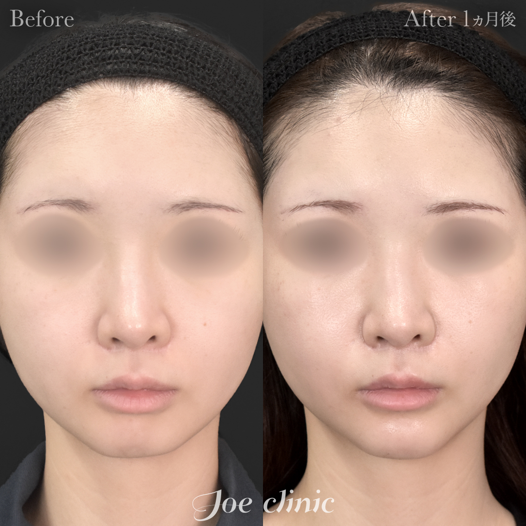 【20代女性】貴族手術（鼻翼基部プロテーゼ挿入術）＋顎プロテーゼ挿入｜1ヵ月後