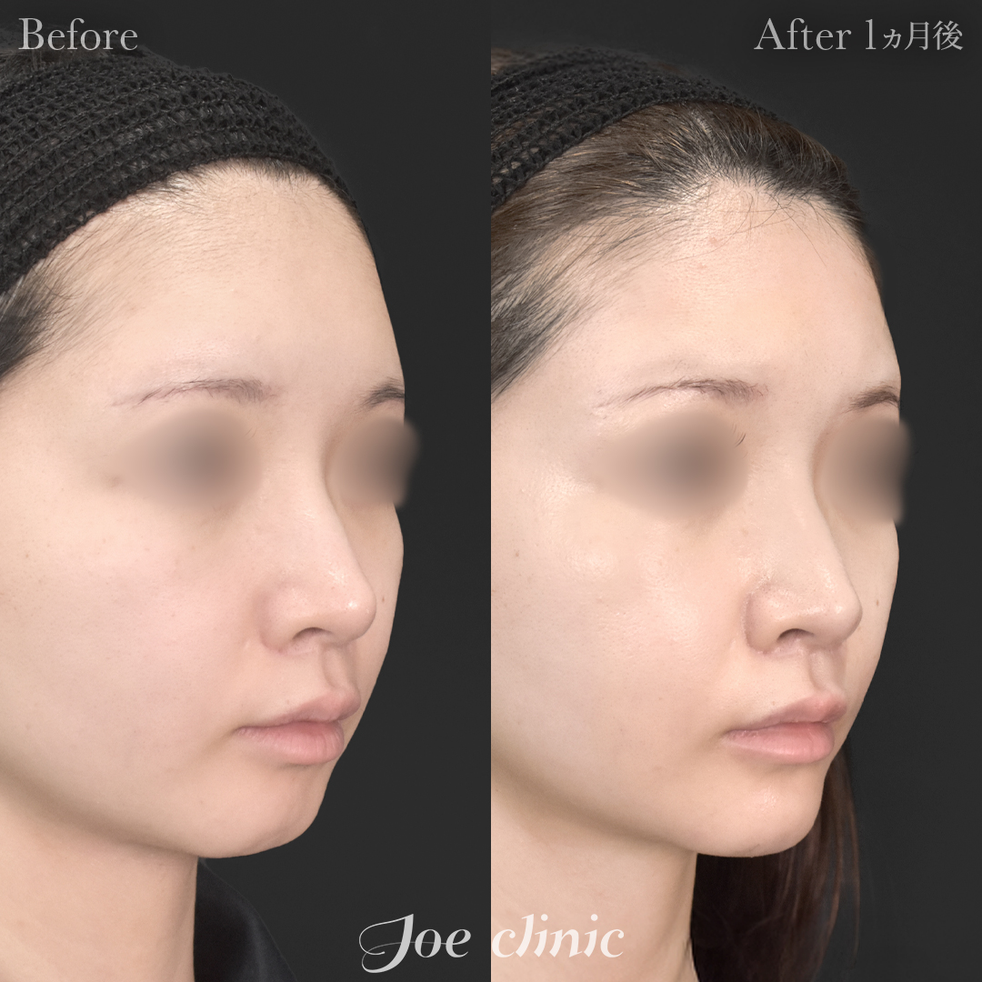 【20代女性】貴族手術（鼻翼基部プロテーゼ挿入術）＋顎プロテーゼ挿入｜1ヵ月後