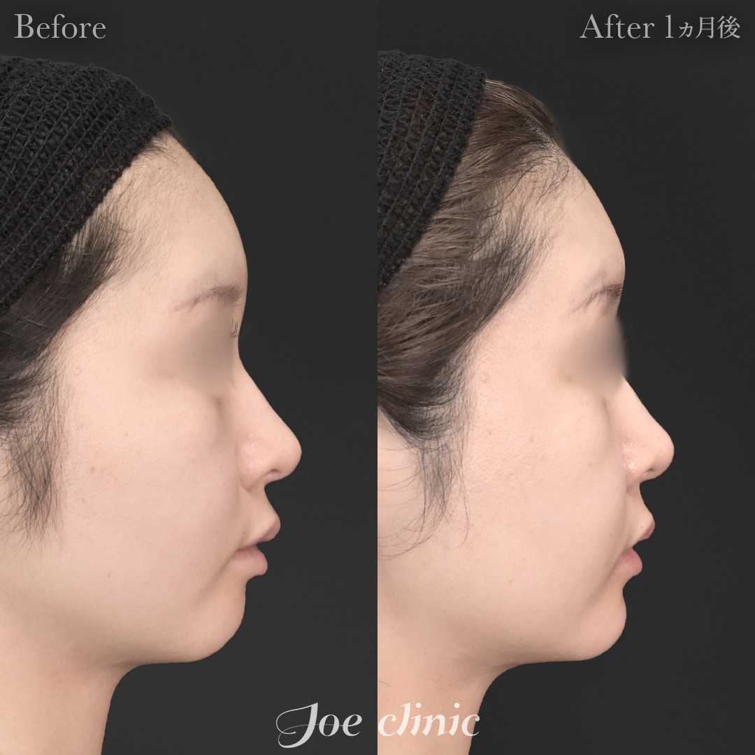 【20代女性】貴族手術（鼻翼基部プロテーゼ挿入術）＋顎プロテーゼ挿入｜1ヵ月後