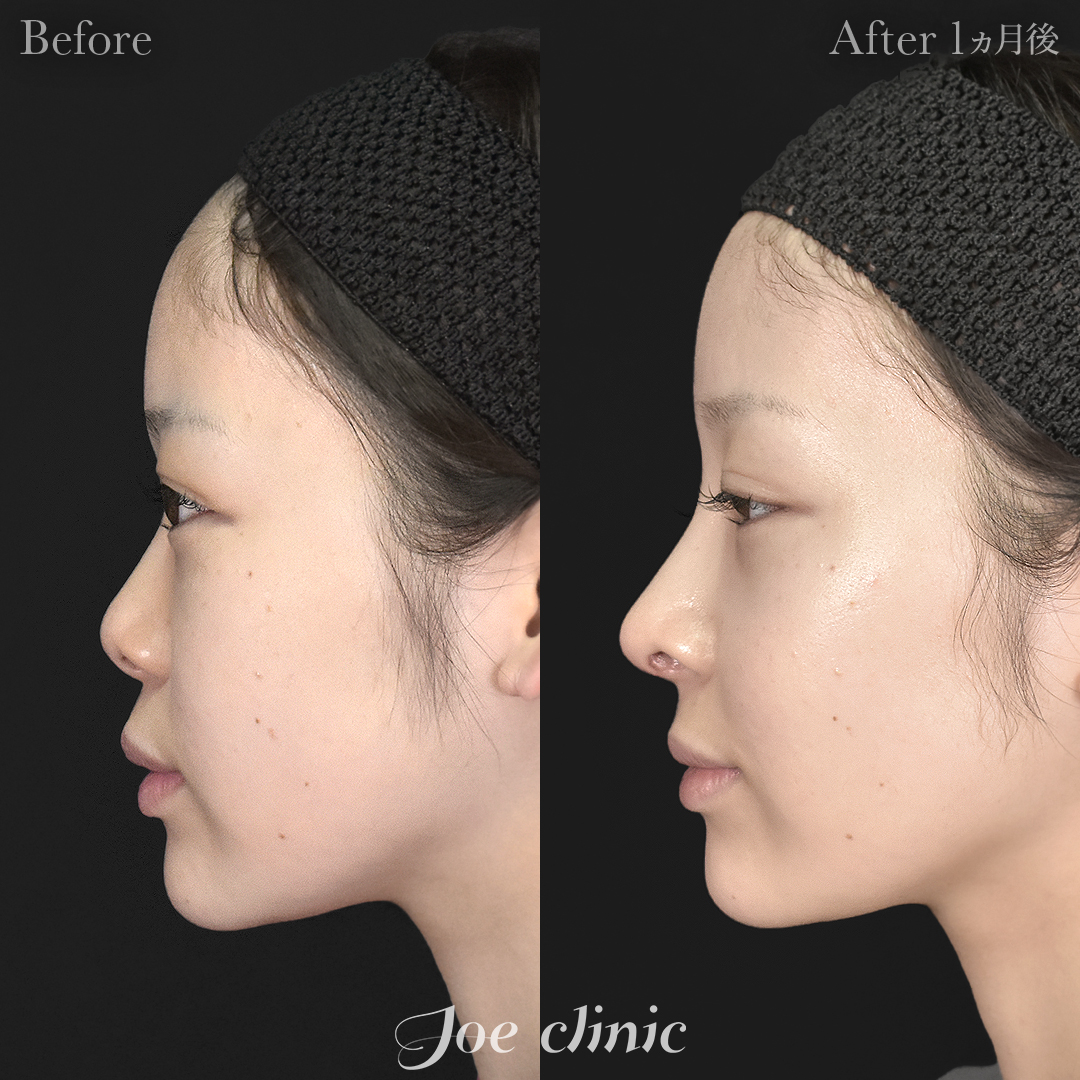 【20代女性】鼻フルコース（鼻複合自家組織移植術）＋鼻プロテーゼ挿入隆鼻術＋貴族フィラー｜1ヵ月後