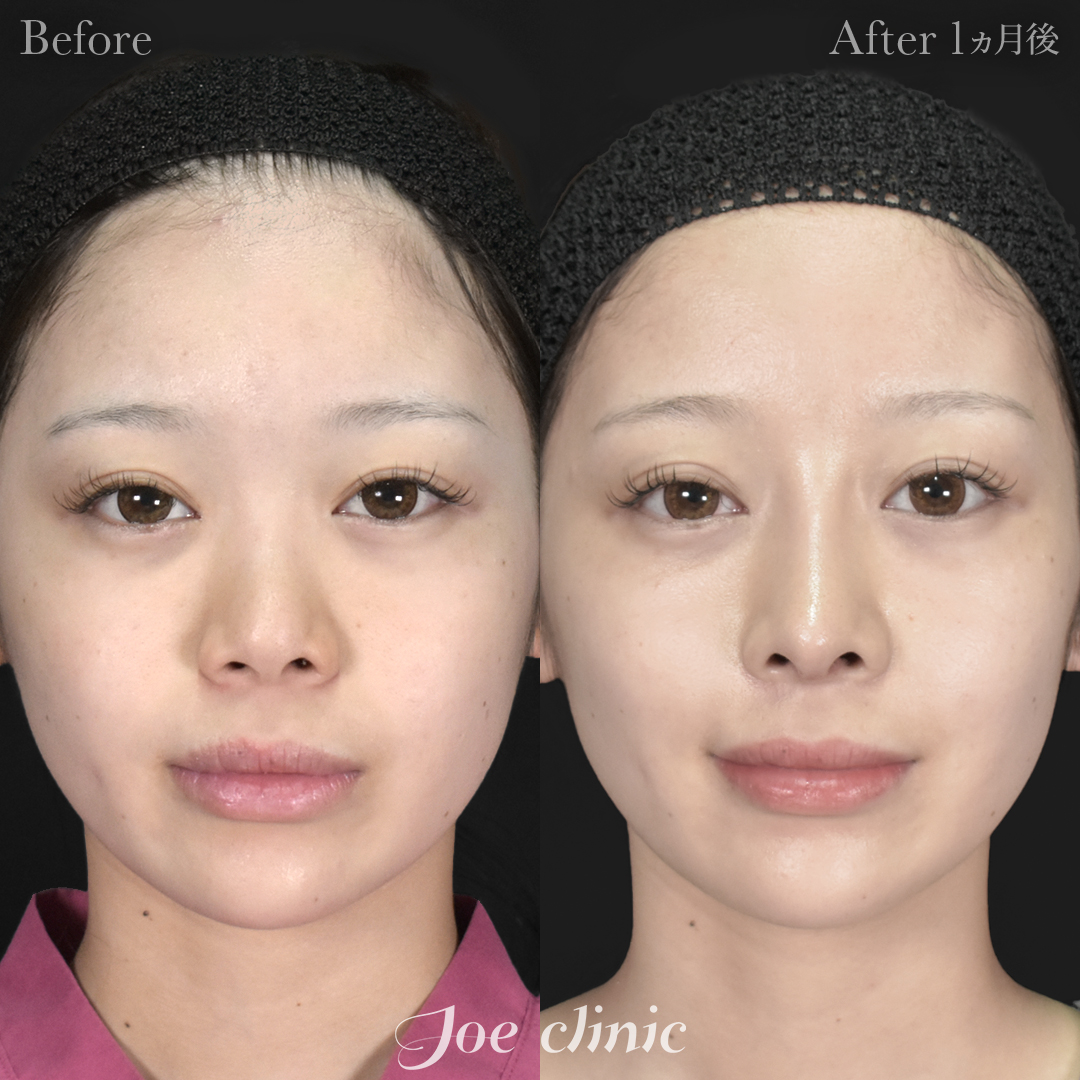 【20代女性】鼻フルコース（鼻複合自家組織移植術 肋軟骨使用）＋鼻プロテーゼ挿入隆鼻術＋貴族フィラー｜1ヵ月後