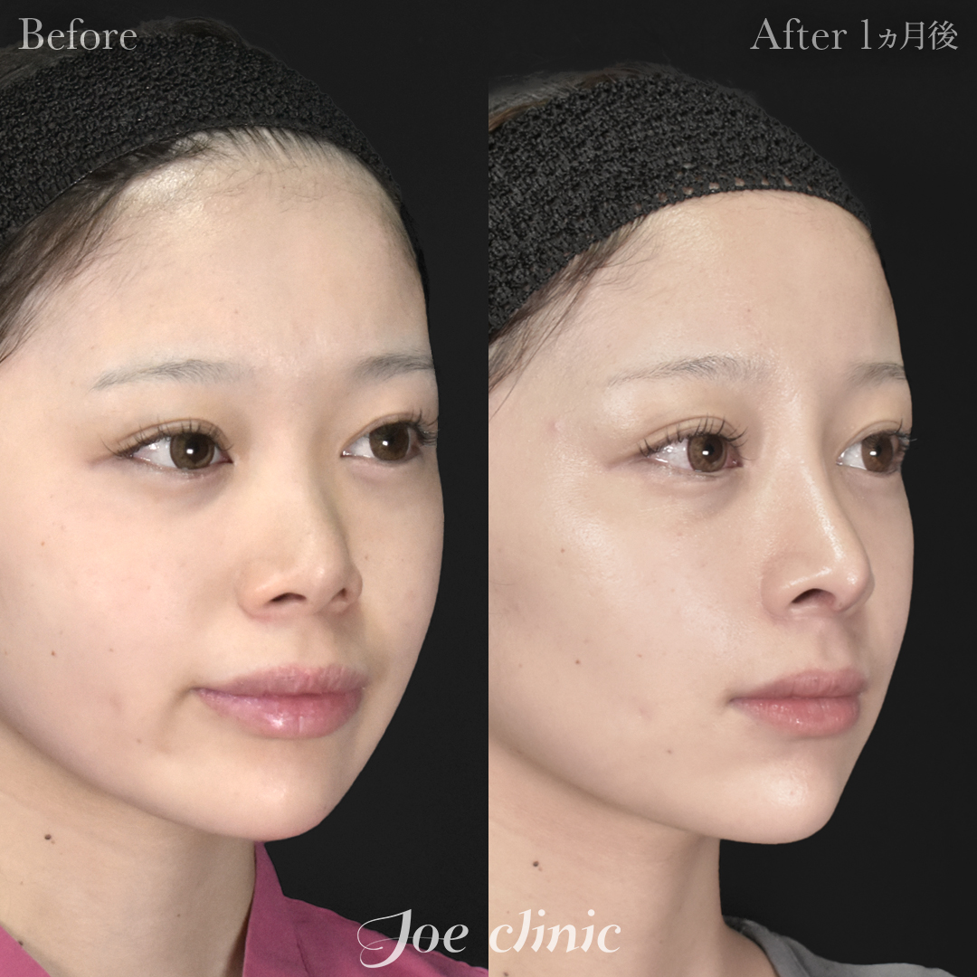 【20代女性】鼻フルコース（鼻複合自家組織移植術 肋軟骨使用）＋鼻プロテーゼ挿入隆鼻術＋貴族フィラー｜1ヵ月後