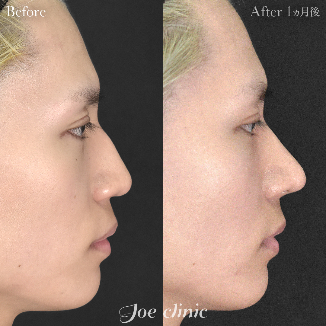 【20代男性】鼻フルコース［クローズ法］（鼻複合自家組織移植術 肋軟骨使用）＋筋膜移植｜1ヵ月後