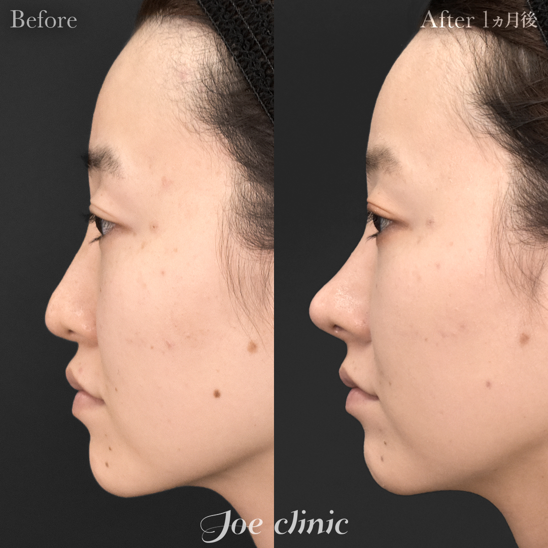 【30代女性・他院修正】他院異物除去＋鼻フルコース［クローズ法］（肋軟骨・耳介軟骨使用）＋筋膜移植＋貴族手術（肋軟骨使用）｜1ヵ月後