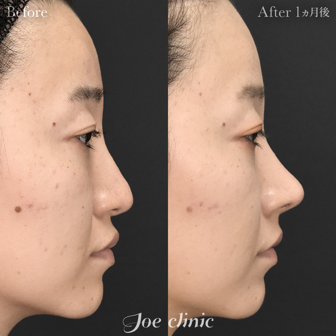 【30代女性・他院修正】他院異物除去＋鼻フルコース［クローズ法］（肋軟骨・耳介軟骨使用）＋筋膜移植＋貴族手術（肋軟骨使用）｜1ヵ月後