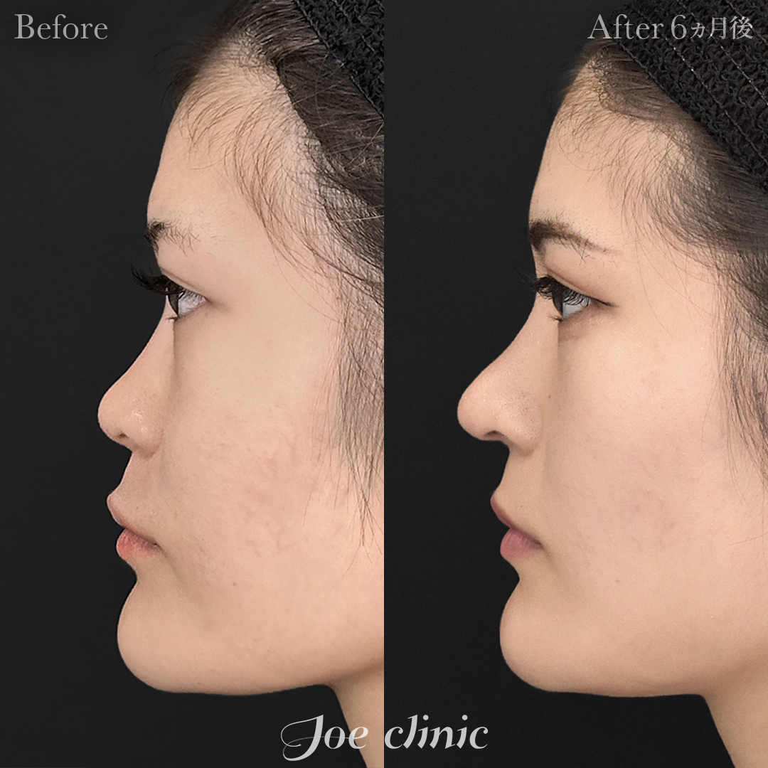 【20代女性】鼻フルコース（鼻複合自家組織移植術）＋鼻プロテーゼ挿入隆鼻術｜6ヵ月後