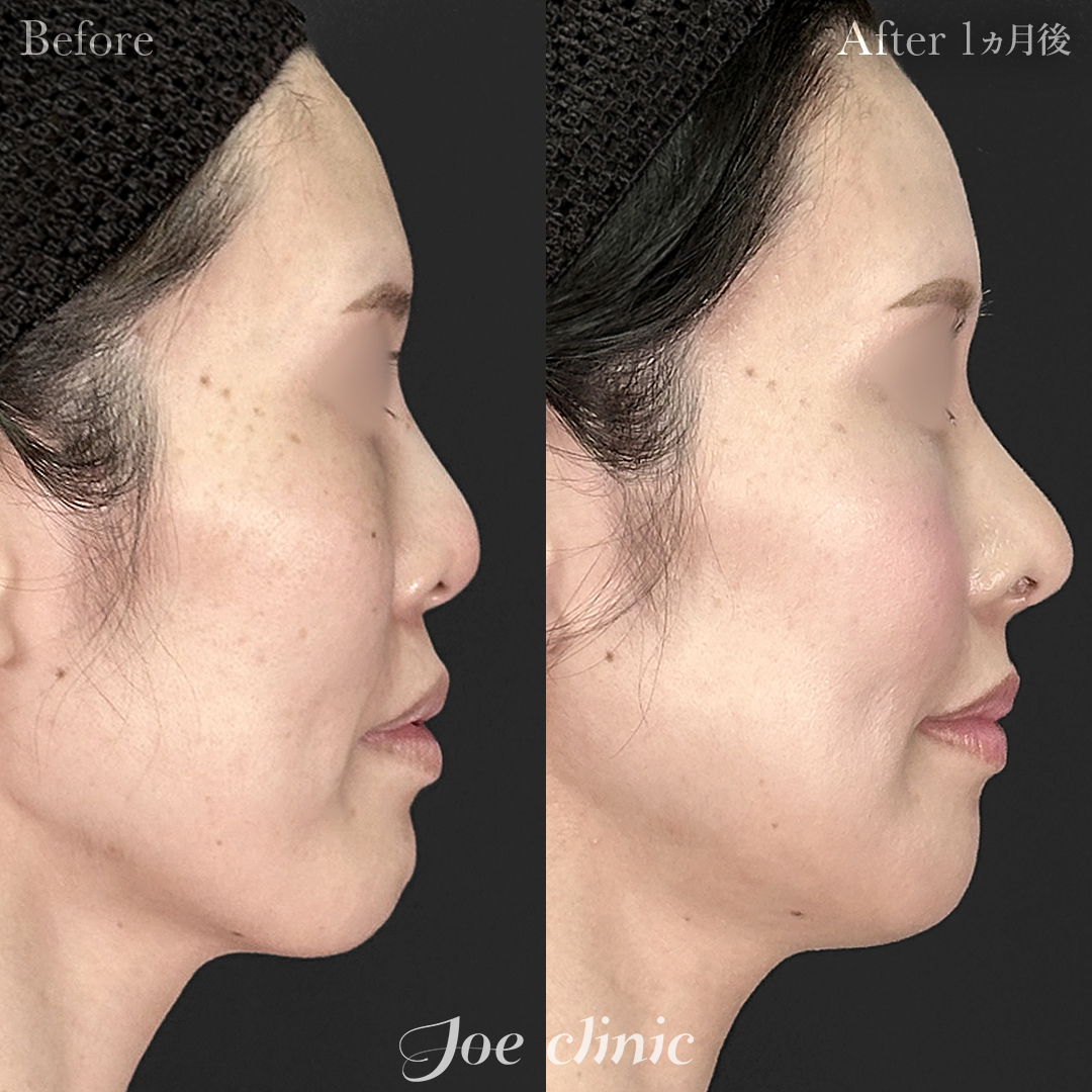 【30代女性・他院修正】他院鼻プロテーゼ入替＋鼻フルコース（肋軟骨使用）＋貴族手術＋Vライン形成｜1ヵ月後