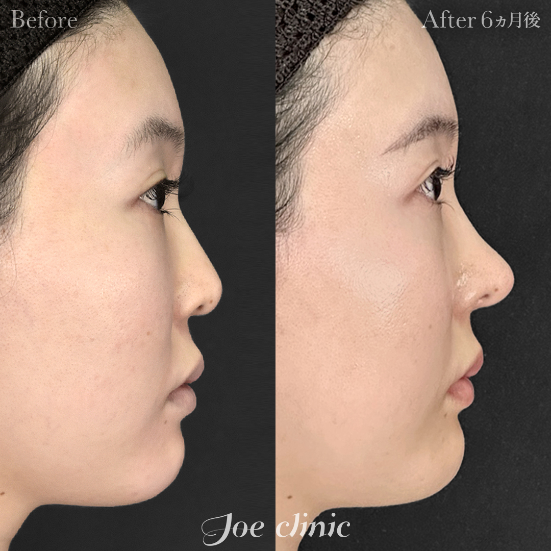 【20代女性】鼻フルコース（鼻複合自家組織移植術 肋軟骨・耳介軟骨使用）｜6ヵ月後