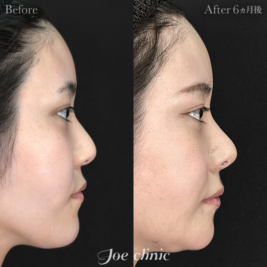 【20代女性】鼻フルコース［クローズ法］（肋軟骨・耳介軟骨使用）＋鼻骨骨切り幅寄せ術＋貴族手術（肋軟骨使用）｜6ヵ月後