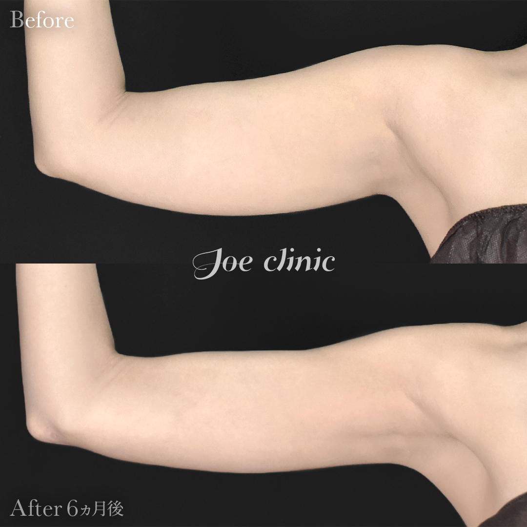 【20代女性】脂肪吸引（二の腕・肩）｜6ヵ月後