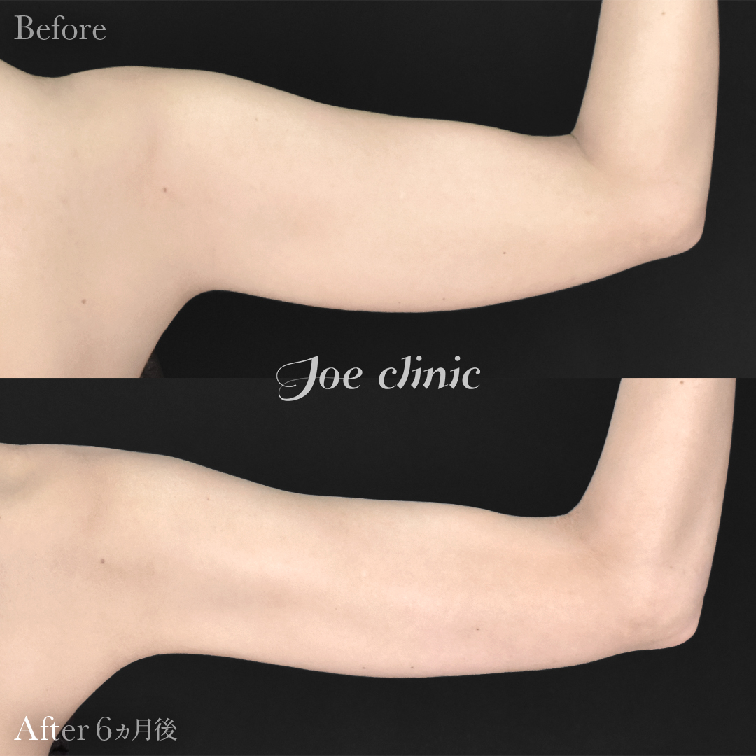 【20代女性】脂肪吸引（二の腕・肩）｜6ヵ月後