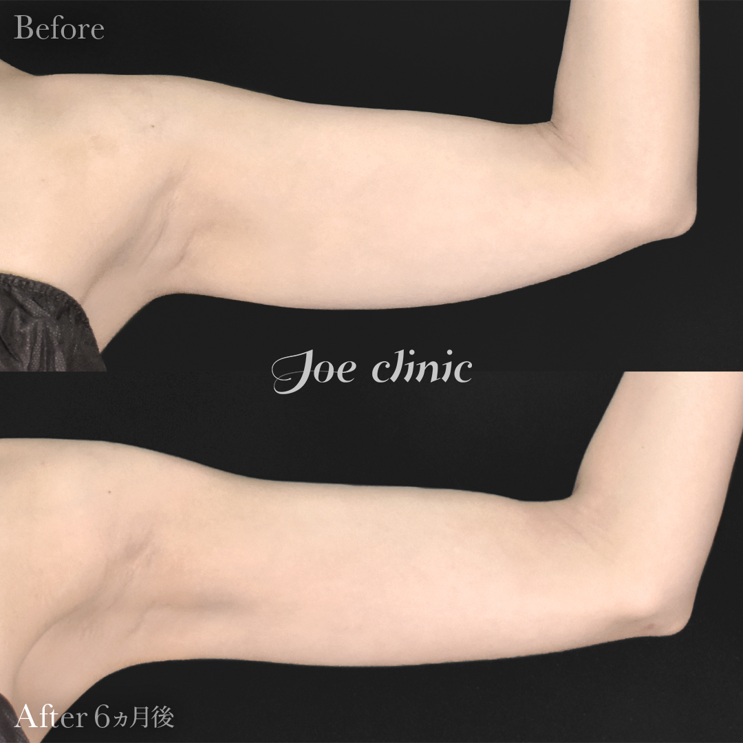 【20代女性】脂肪吸引（二の腕・肩）｜6ヵ月後
