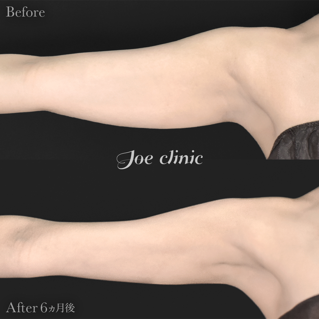 【20代女性】脂肪吸引（二の腕・肩）｜6ヵ月後