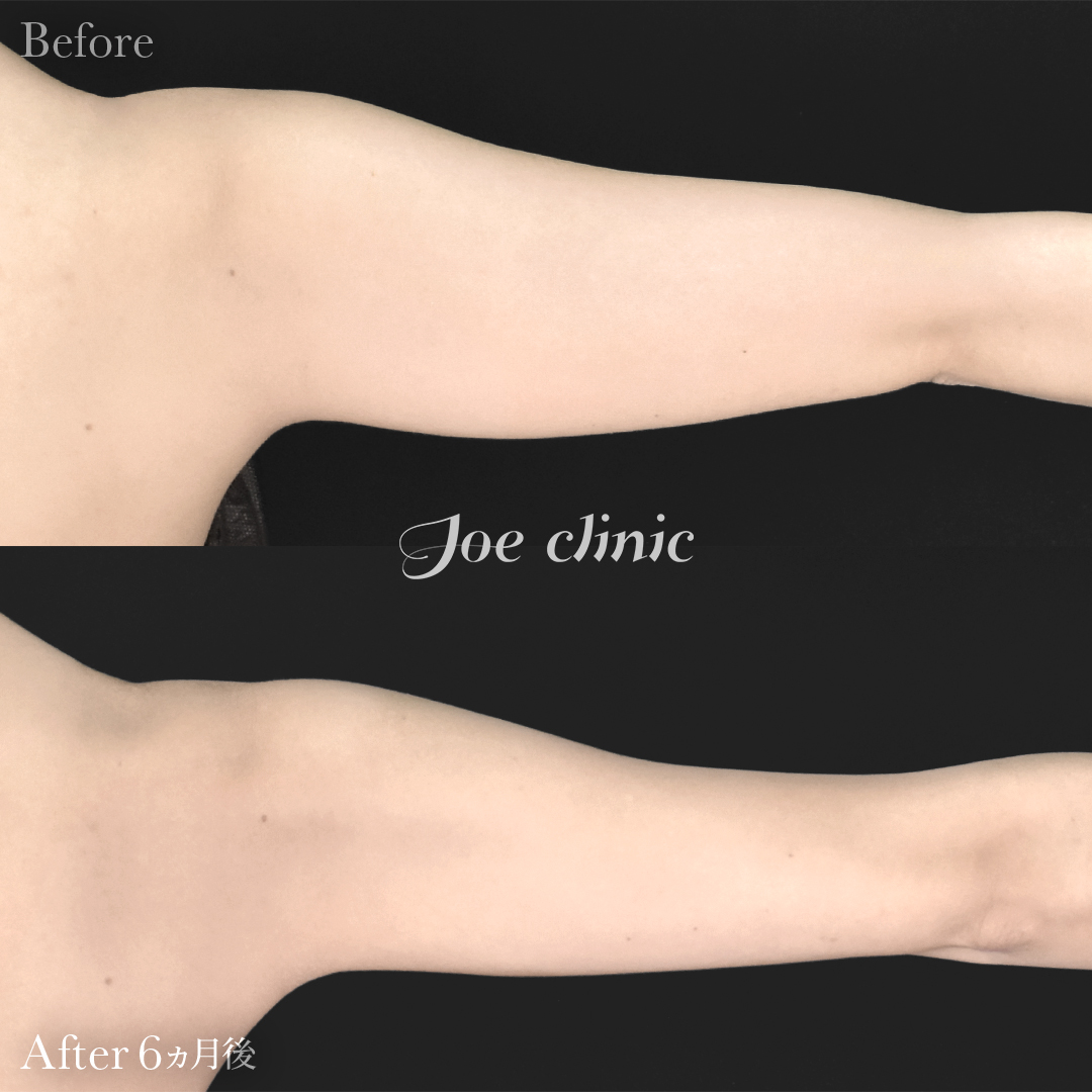 【20代女性】脂肪吸引（二の腕・肩）｜6ヵ月後