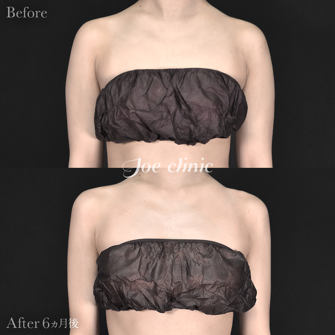 【20代女性】脂肪吸引（二の腕・肩）｜6ヵ月後