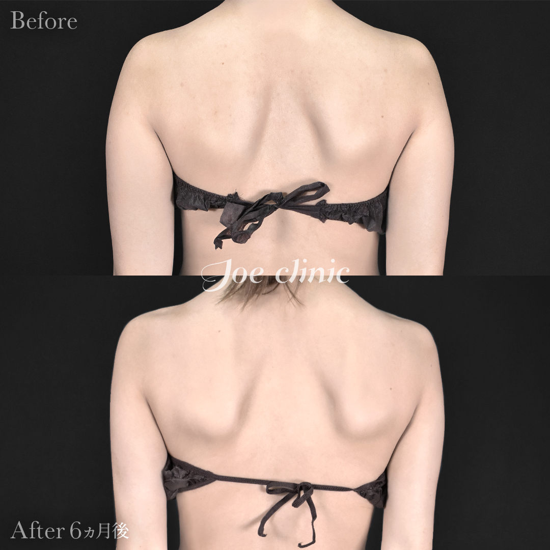 【20代女性】脂肪吸引（二の腕・肩）｜6ヵ月後