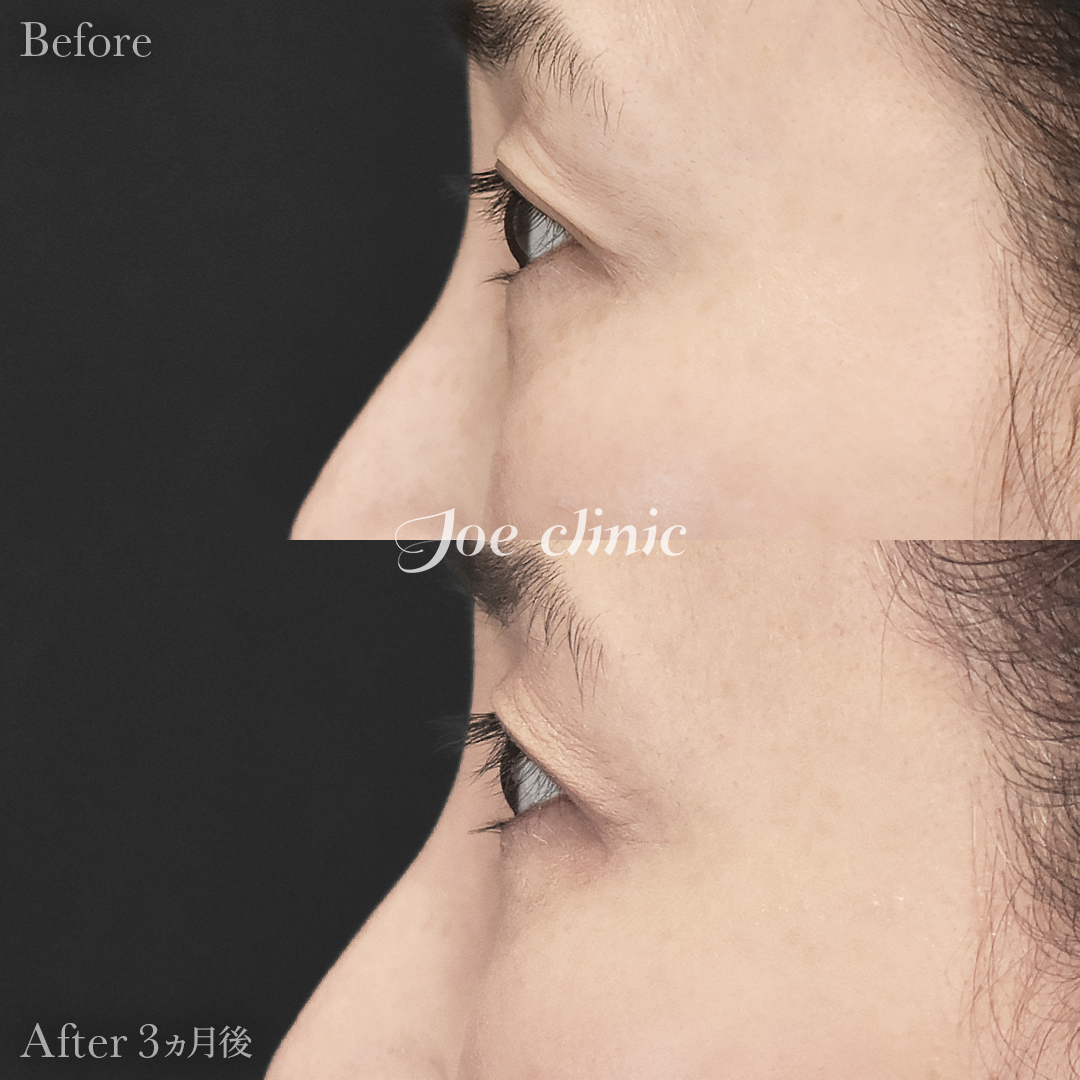 【50代女性】目の下のクマ取り（裏ハムラ法）｜3ヵ月後