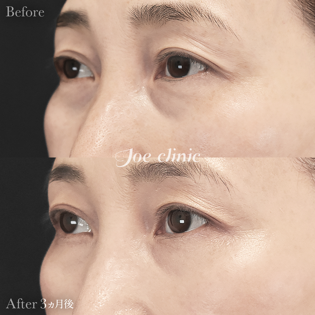 【50代女性】目の下のクマ取り（裏ハムラ法）｜3ヵ月後