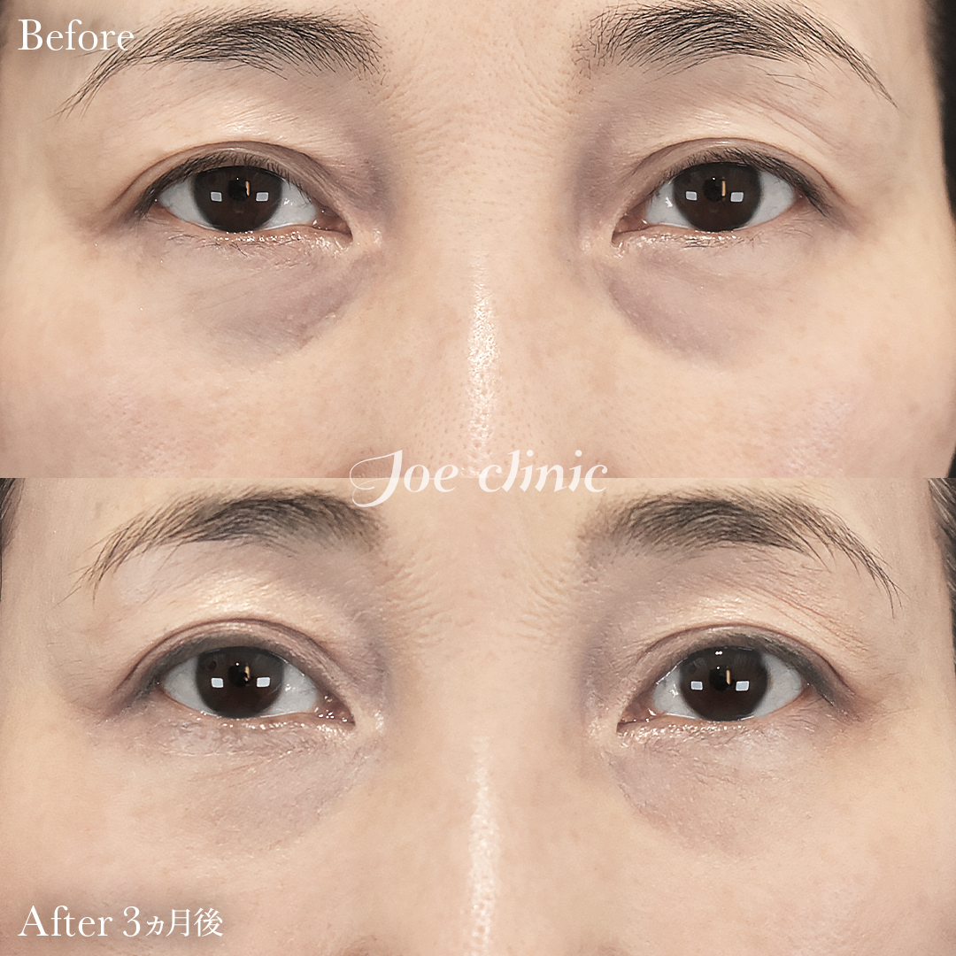 【50代女性】目の下のクマ取り（裏ハムラ法）｜3ヵ月後