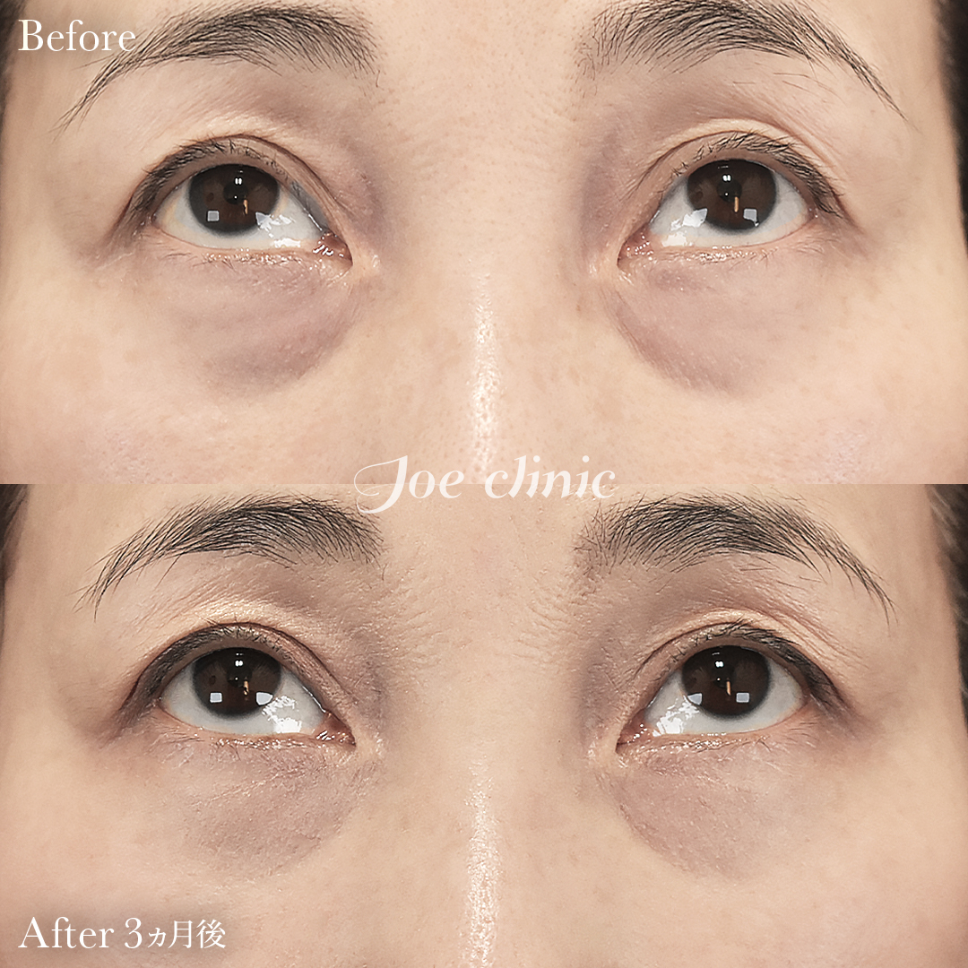 【50代女性】目の下のクマ取り（裏ハムラ法）｜3ヵ月後