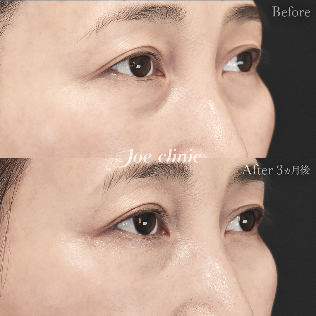 【50代女性】目の下のクマ取り（裏ハムラ法）｜3ヵ月後