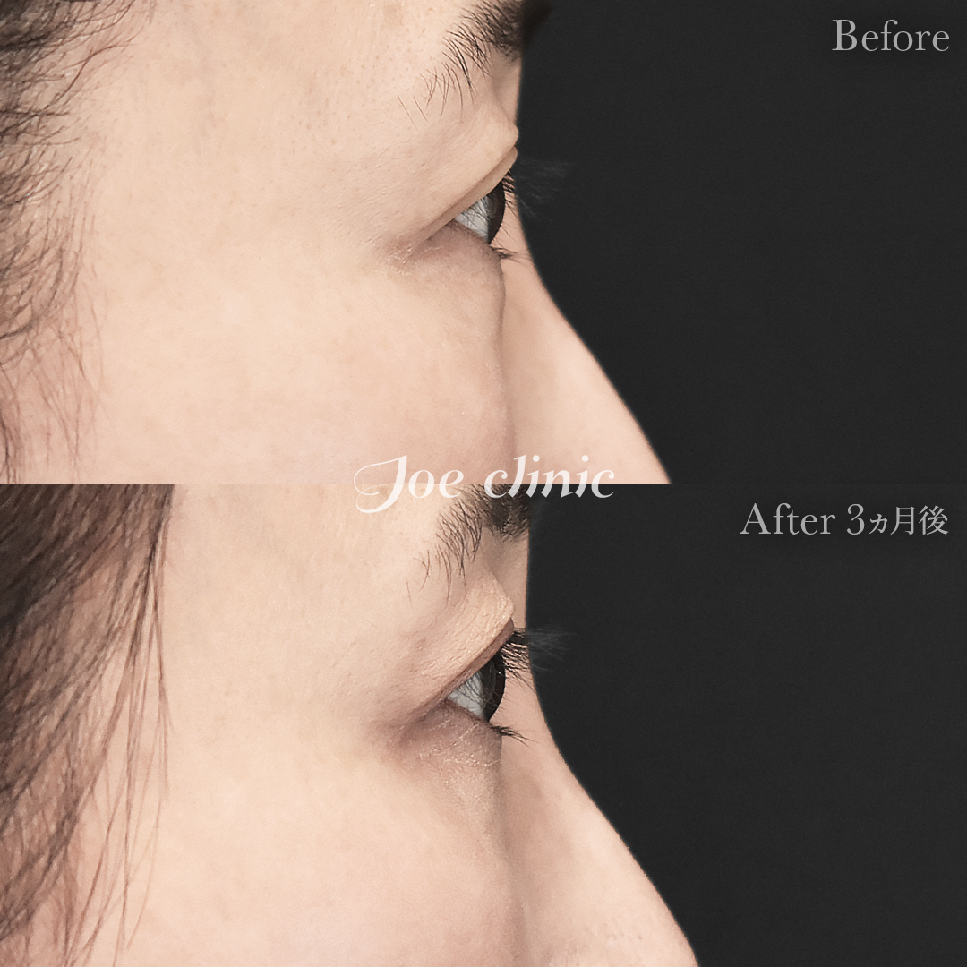 【50代女性】目の下のクマ取り（裏ハムラ法）｜3ヵ月後