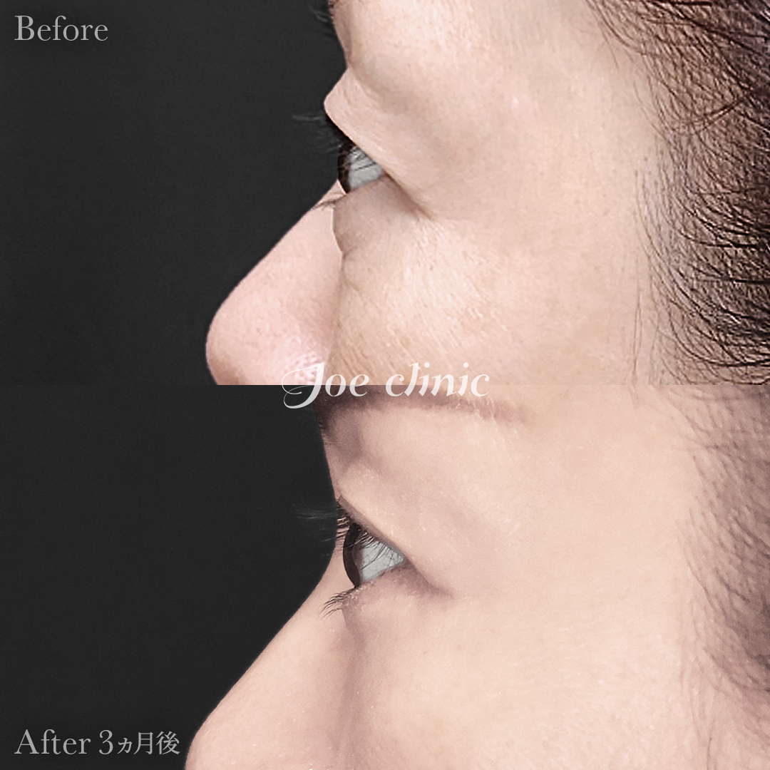 【50代女性】ミッドフェイスリフト＋目の下のクマ取り（たるみ取り術・ハムラ法）＋眉下リフト｜3ヵ月後