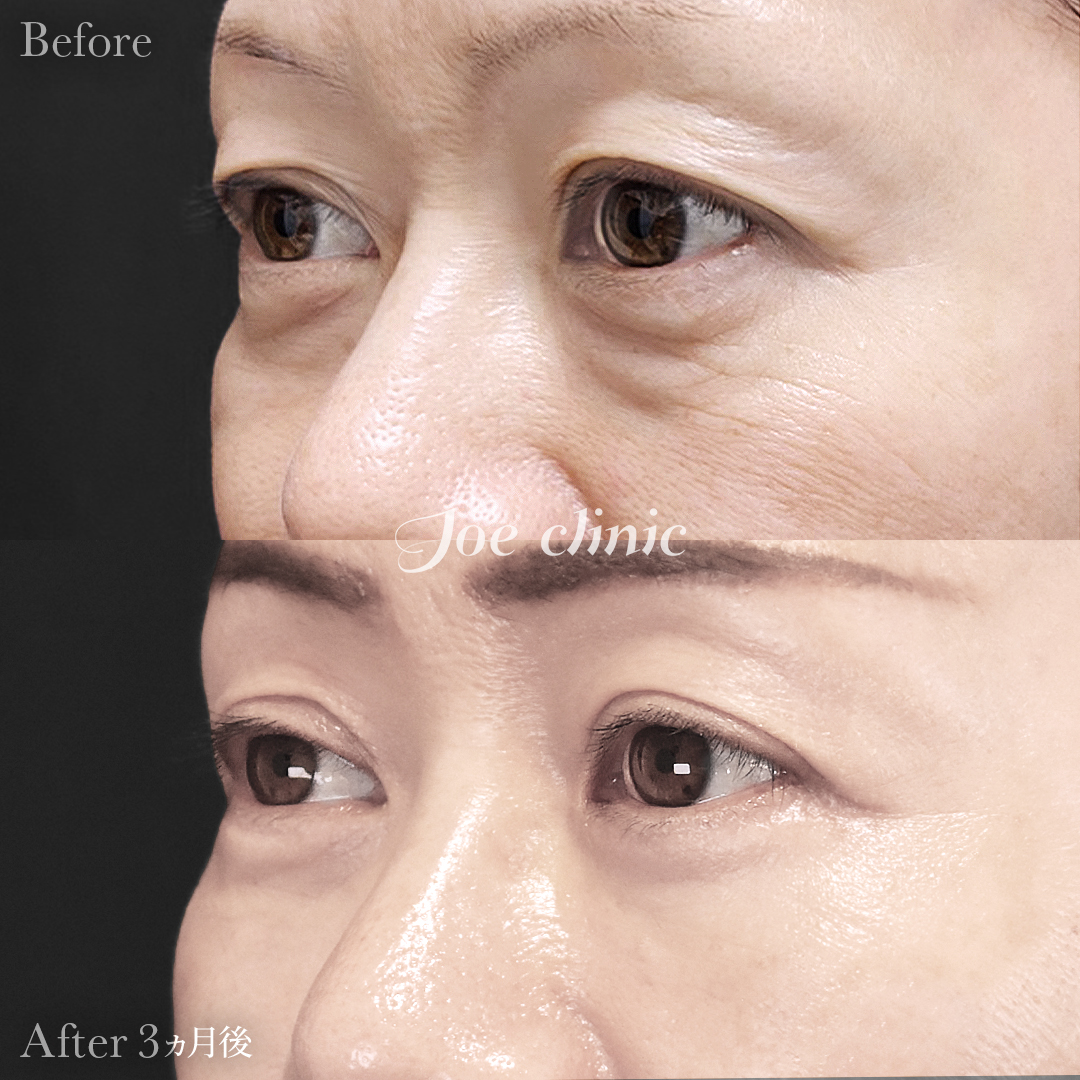 【50代女性】ミッドフェイスリフト＋目の下のクマ取り（たるみ取り術・ハムラ法）＋眉下リフト｜3ヵ月後