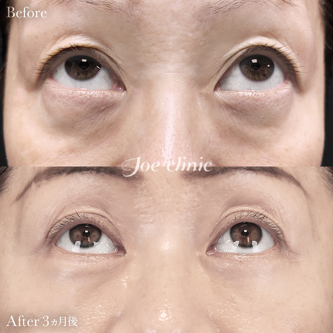 【50代女性】ミッドフェイスリフト＋目の下のクマ取り（たるみ取り術・ハムラ法）＋眉下リフト｜3ヵ月後