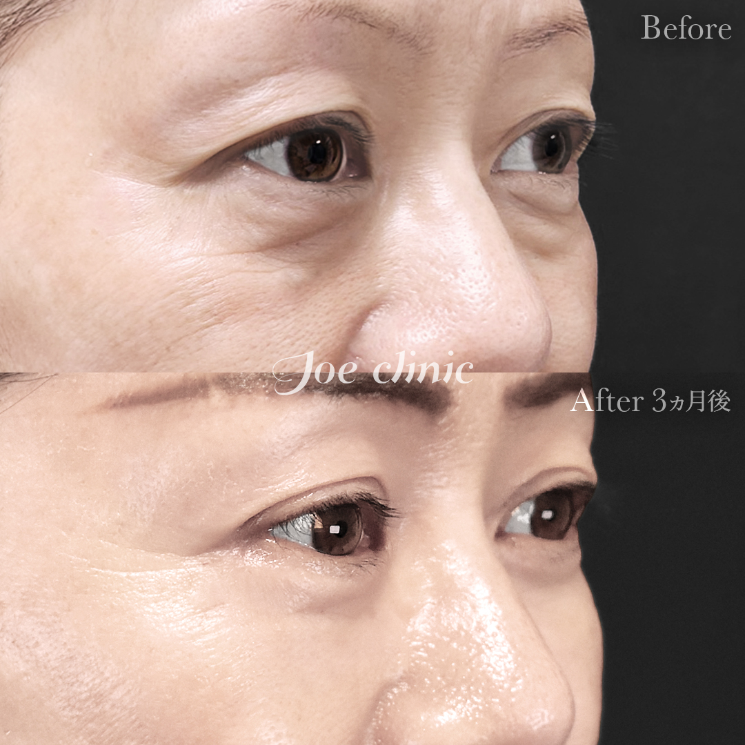 【50代女性】ミッドフェイスリフト＋目の下のクマ取り（たるみ取り術・ハムラ法）＋眉下リフト｜3ヵ月後