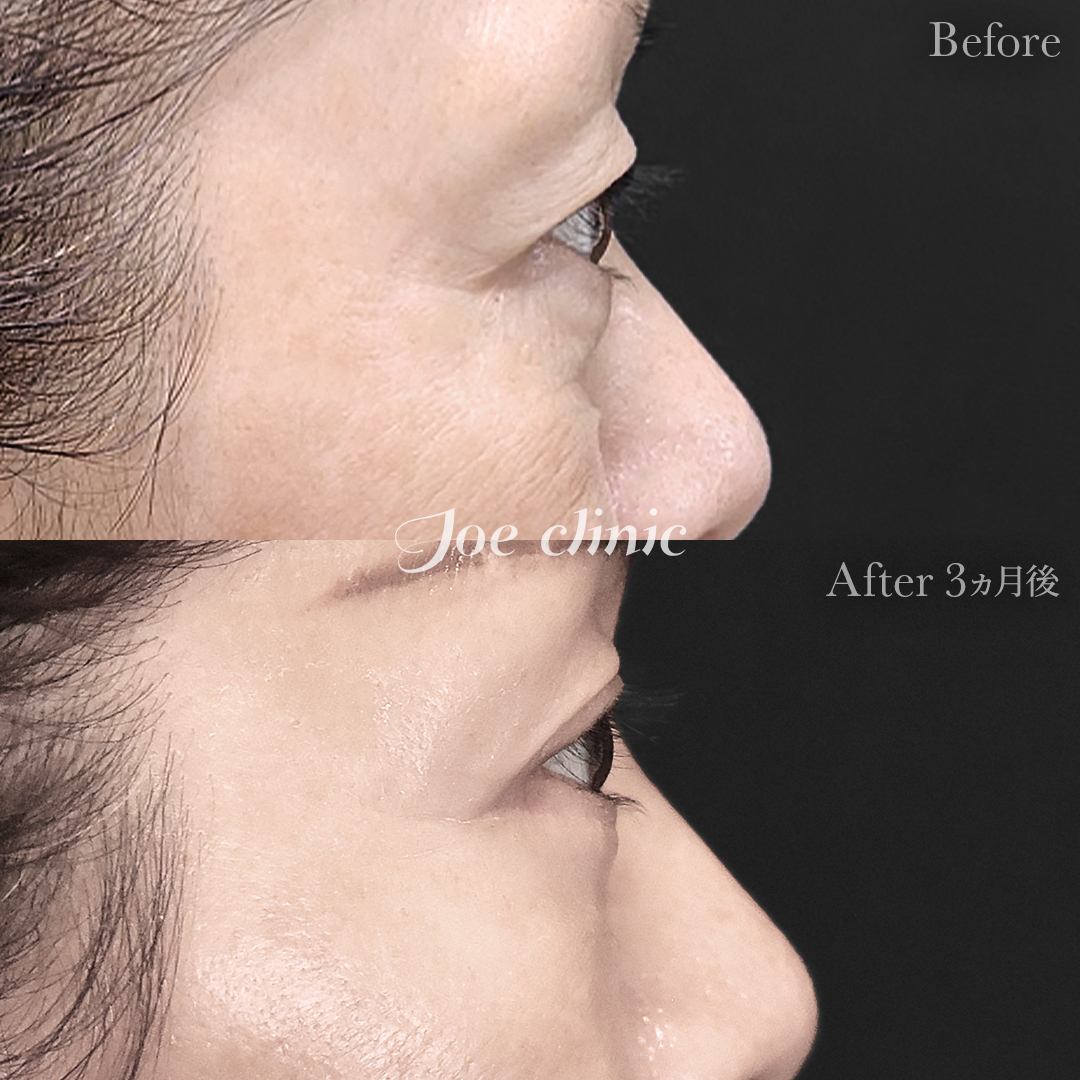 【50代女性】ミッドフェイスリフト＋目の下のクマ取り（たるみ取り術・ハムラ法）＋眉下リフト｜3ヵ月後