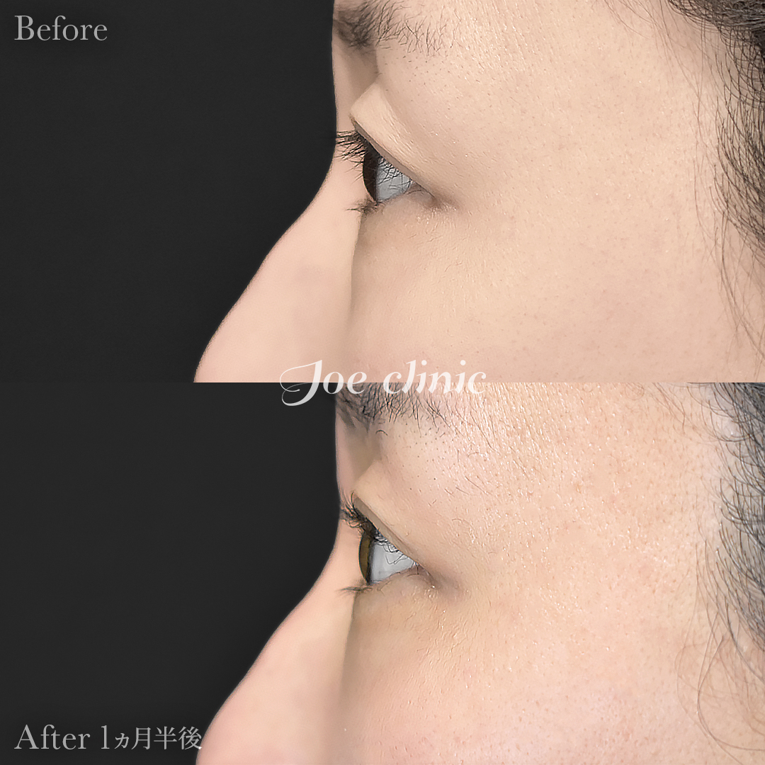 【30代女性】目の下のクマ取り（裏ハムラ法）｜1ヵ月半後