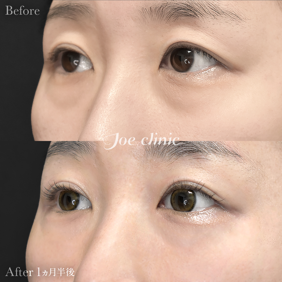 【30代女性】目の下のクマ取り（裏ハムラ法）｜1ヵ月半後