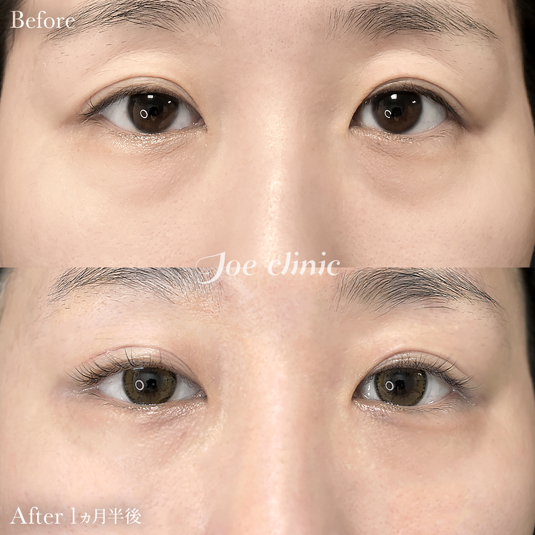 【30代女性】目の下のクマ取り（裏ハムラ法）｜1ヵ月半後