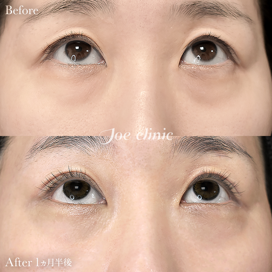 【30代女性】目の下のクマ取り（裏ハムラ法）｜1ヵ月半後