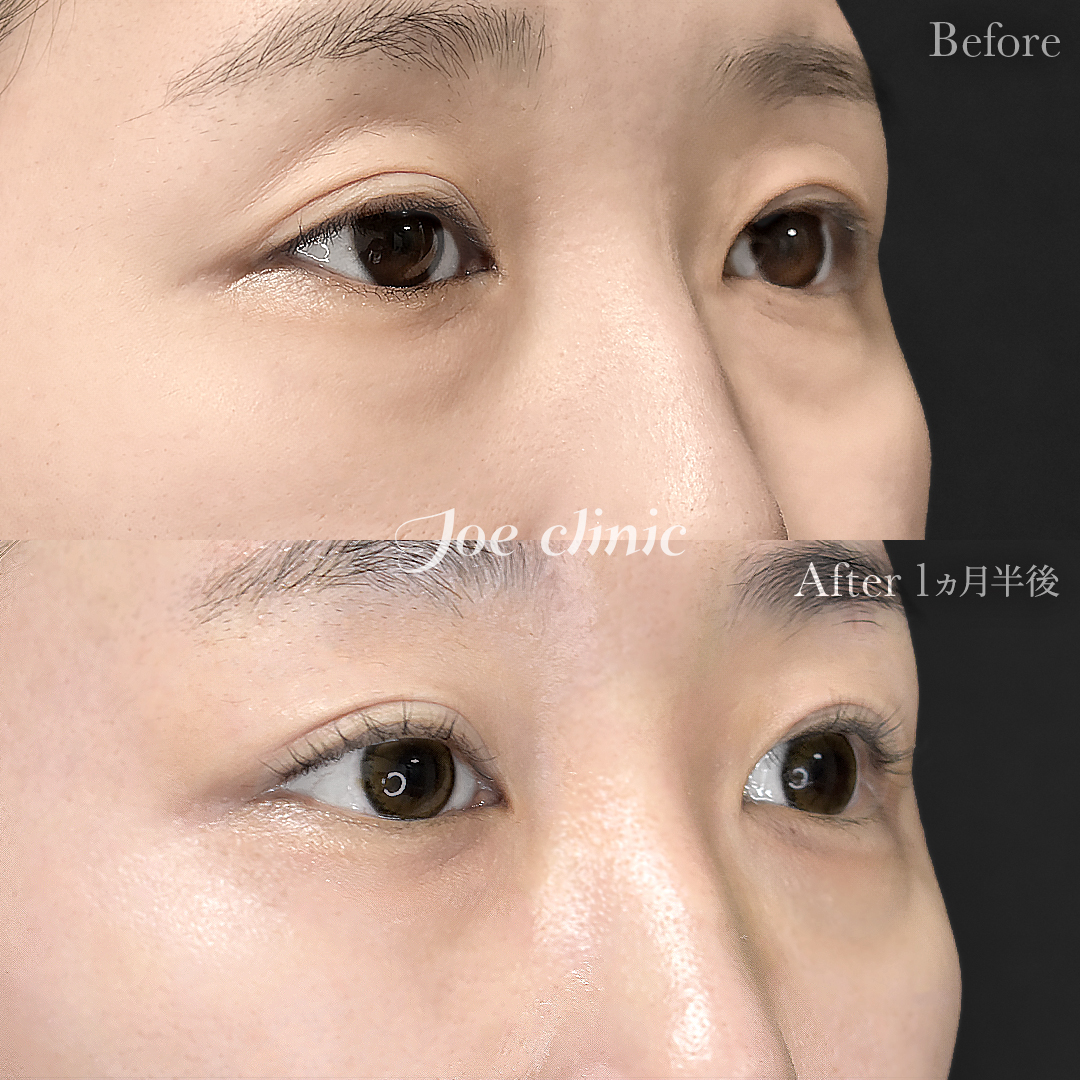 【30代女性】目の下のクマ取り（裏ハムラ法）｜1ヵ月半後